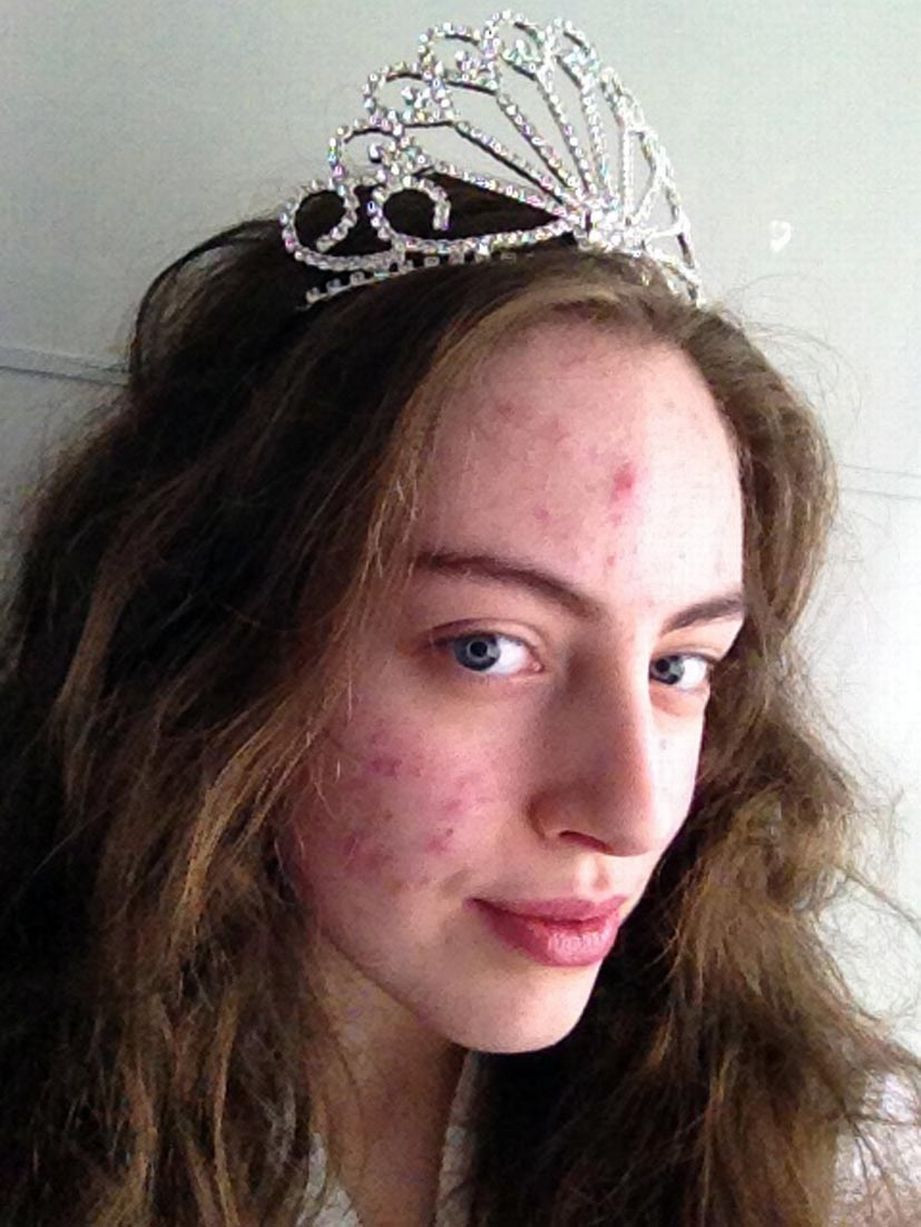 Sufera de o forma severa de acnee si nu iese din casa fara machiaj. Cum arata tanara care a castigat un concurs de frumusete