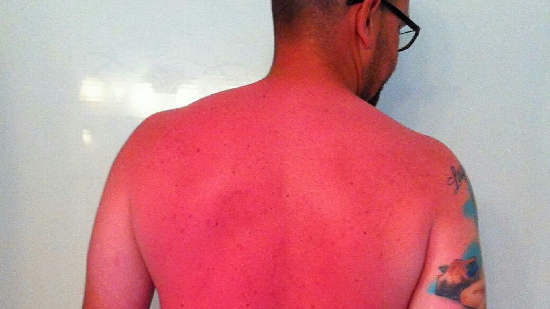 Arsurile teribile cu care s-a ales un barbat dupa o zi de plaja, fara crema de protectie solara. Poza devenita viral