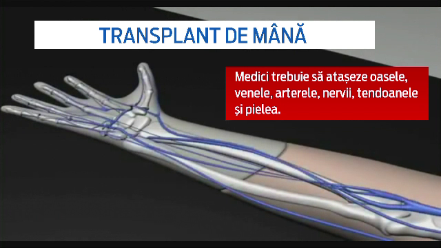 Primul transplant de mana din Romania se va face la Cluj. In intreaga lume, doar 70 de oameni au trecut prin aceasta operatie