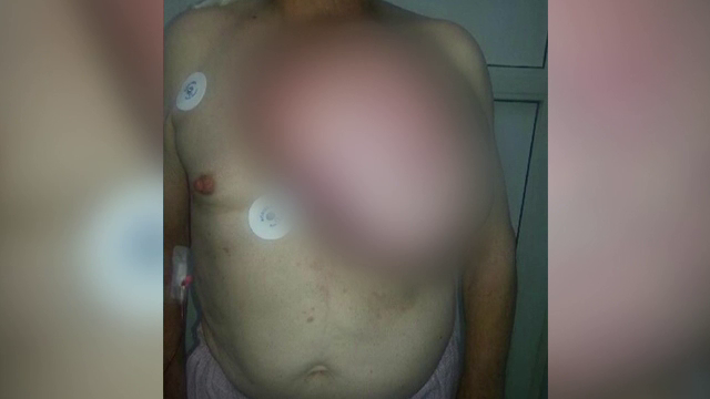 Premiera pentru Spitalul Judetean din Baia Mare. Medicii au operat un barbat de 86 de ani, cu o tumoare de 6kg pe piept