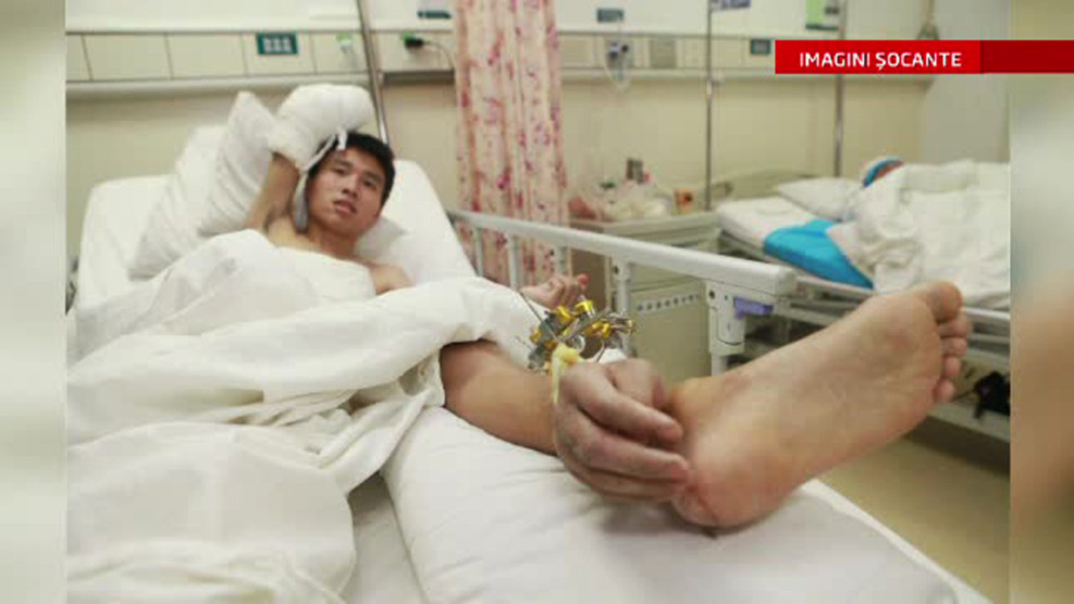 Operatie uluitoare in China. Motivul pentru care medicii i-au transplantat unui barbat mana pe picior
