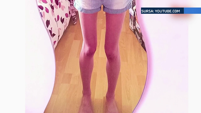 “Ma vedeam dezgustator de grasa”. Marturiile tulburatoare ale unei tinere de 14 ani, la un pas sa moara de anorexie
