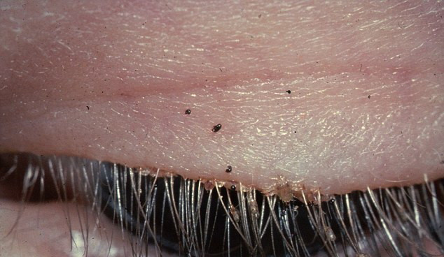 Fiul ei a vazut ca i se misca "ceva" in zona genelor. Ce a descoperit un oftalmolog in ochiul unei femei