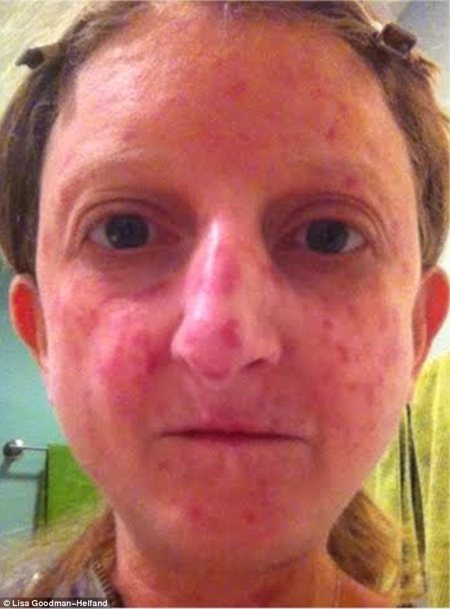 scleroderma