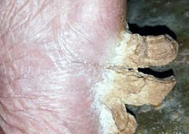 Agonie pentru o femeie din Arabia Saudita dupa ce i-au crescut in talpa "coarne cutanate"