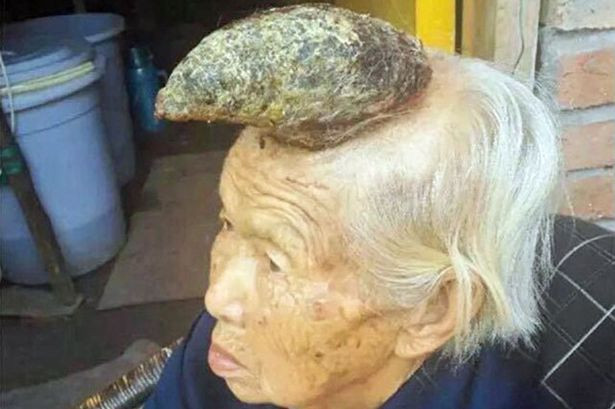 "Femeia-unicorn", misterul medical care i-a bulversat pe doctorii chinezi. Ce i-a aparut pe frunte unei batrane de 87 de ani