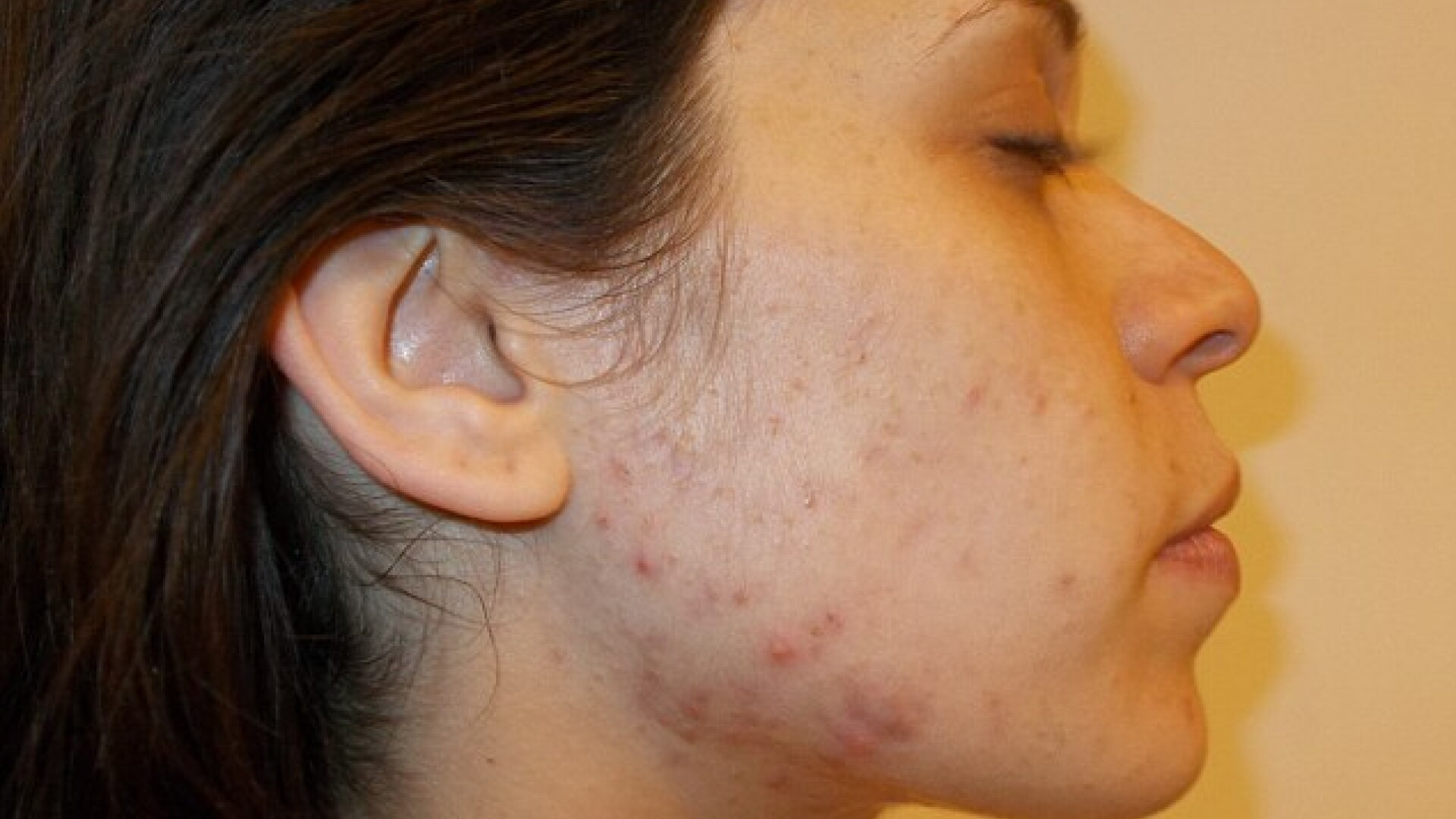 A avut o eruptie severa de acnee si a vrut sa-si anuleze nunta din acest motiv. Cum a aratat aceasta femeie in ziua cea mare