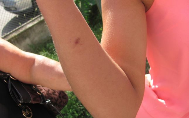 Un nou scandal sexual in Vaslui. O fata de 15 ani sustine ca a fost violata, arsa cu tigara si filmata de doi tineri