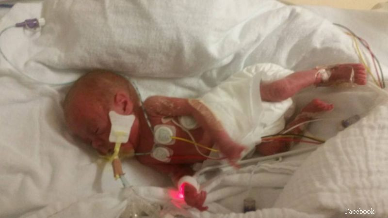 A nascut cu 4 luni mai devreme, iar medicii i-au zis ca bebelusul are 1% sanse de supravietuire. Cum arata acum fetita