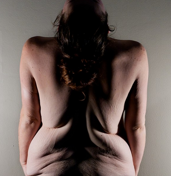 Efectele unei slabiri dramatice: cum arata corpul acestei femei, dupa ce a ajuns de la 153 de kg la 81 de kg