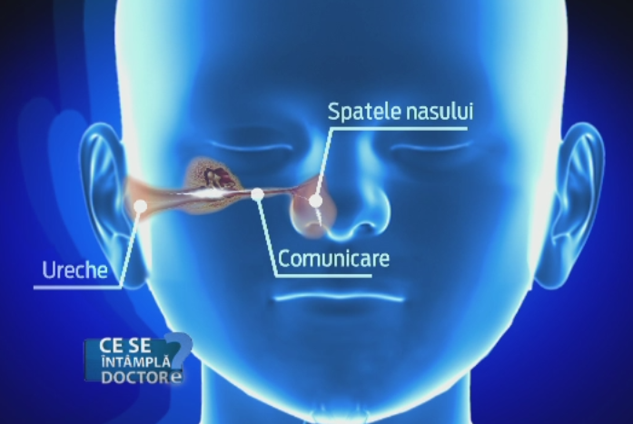 Otita medie seroasa, cea mai frecventa afectiune a urechii. Efectele periculoase pe care le poate avea la copii
