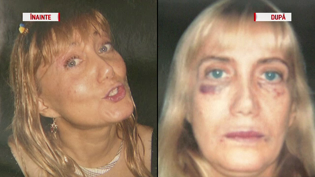 O romanca sustine ca s-a chinuit un an sa repare ce ar fi distrus un estetician in cateva minute. "S-a umflat ca un balon"