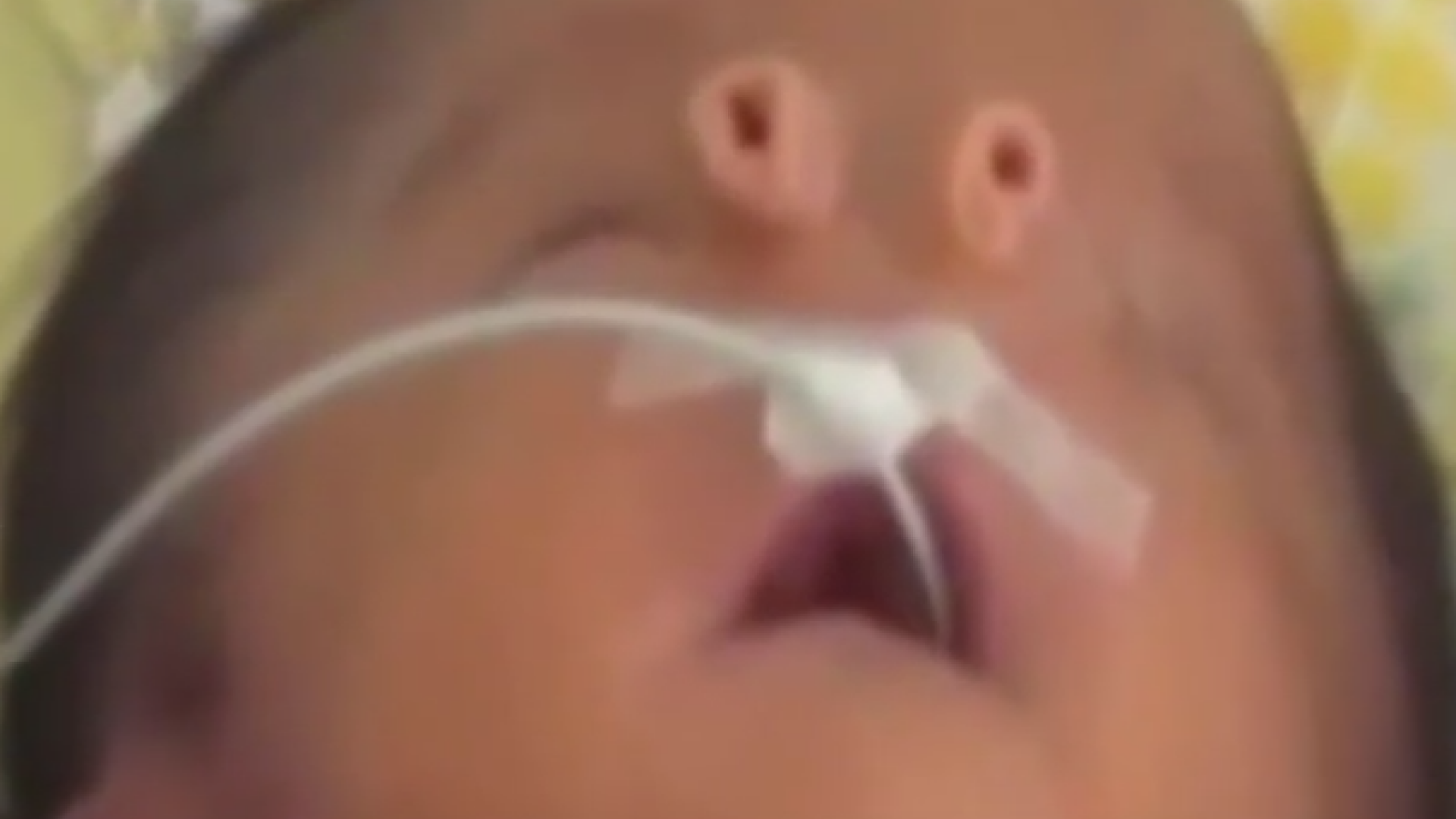 Cum arata baietelul care s-a nascut cu doua nasuri. Acest sindrom apare o data la 15.000 de cazuri. VIDEO