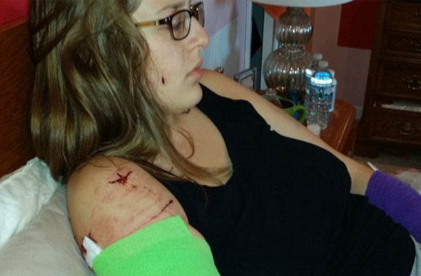 Ranile infioratoare cu care s-au ales doua verisoare atacate de patru pitbulli, in timp ce faceau jogging. FOTO