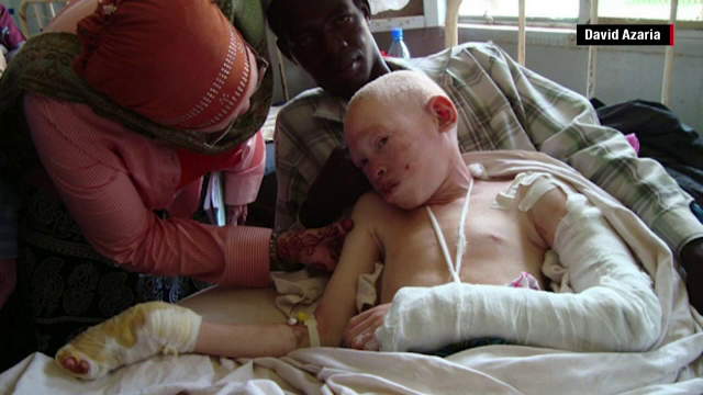 I-au taiat piciorul si degetele de la mana pentru ca au crezut ca are oase fermecate. Drama prin care a trecut o adolescenta