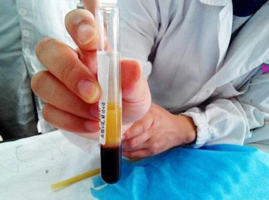 A mancat numai grasimi incat doctorii au descoperit ca are sangele galben