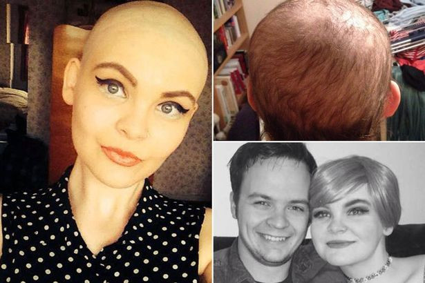 A fost batjocorita de colegi, asa ca a inceput sa-si smulga parul din cauza stresului. Cum a ajuns sa arate aceasta tanara