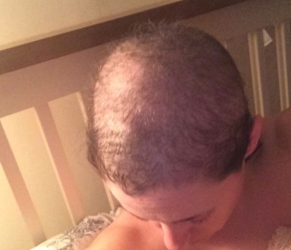 O britanica a invins dupa 20 de ani de boala care a facut-o sa-si smulga aproape tot parul din cap