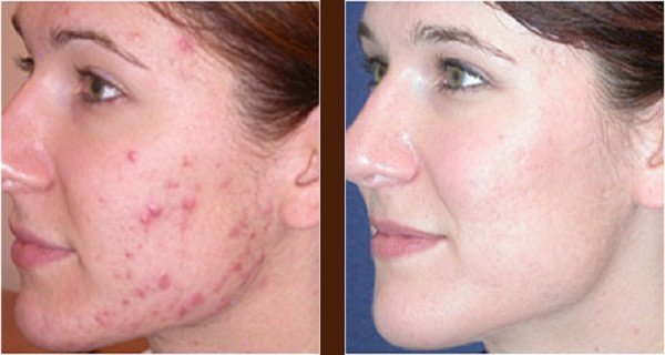 Cum scapati de acnee in trei zile. Remediul se afla si in camara ta