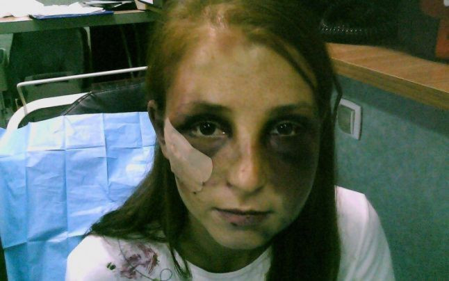 Barbatul care si-a batut iubita timp de 22 de ore, trimis in judecata. Femeia are nevoie de 16.000 de fire de par