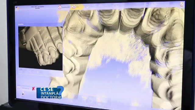 O dantura noua in cateva ore. Ultima descoperire a stomatologilor asigura ca nu veti mai avea niciodata probleme cu cariile