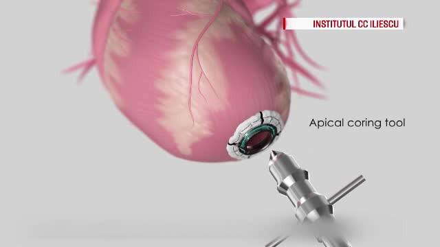 Un roman grav bolnav a primit o inima artificiala de 80.000 de euro, care se poate incarca la priza sau in masina