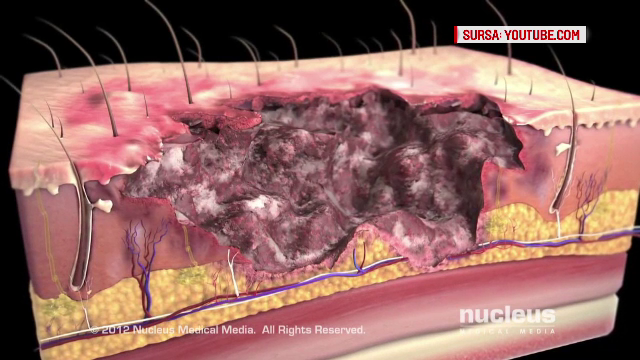 Ranitii din Colectiv au intrat de luni intr-un amplu program de recuperare. Ce urmeaza pentru toti pacientii cu arsuri