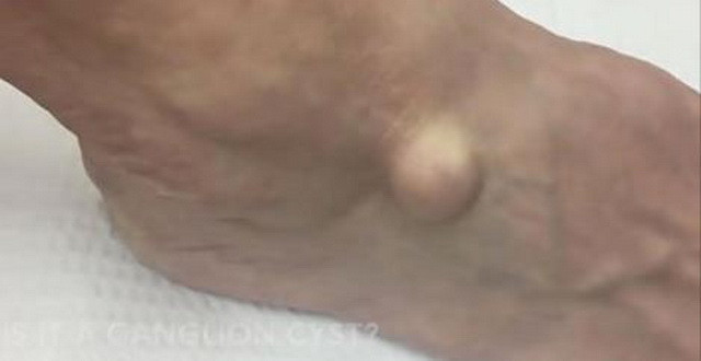 S-a dus la doctor cu o umflatura misterioasa pe picior! Medicii au ramas fara cuvinte cand au vazut ce avea sub piele