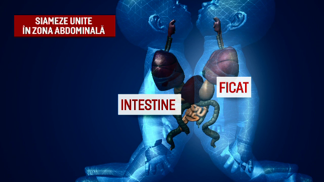 Femeia din Constanta care a nascut siameze nu a fost la niciun control in sarcina. Fetitele, duse la Spitalul "Marie Curie"