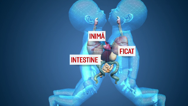 Cazul siamezelor care impart aceeasi inima. Medicii romani vor sa ii ceara ajutorul unui posibil candidat la presedintia SUA