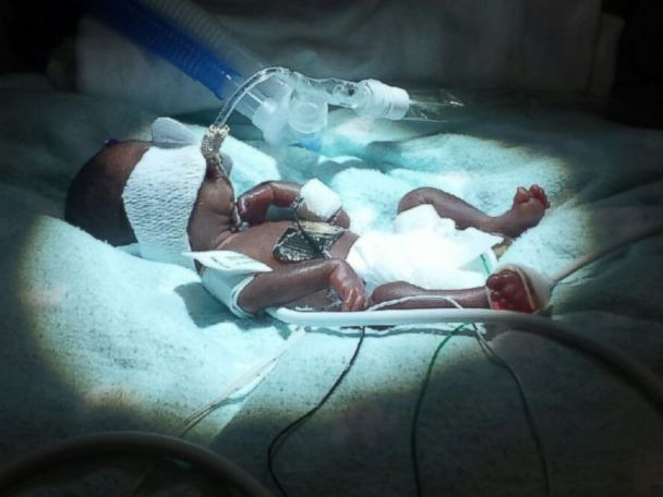 Reusita uriasa la un spital american. Cel mai mic copil prematur din lume a supravietuit, desi a avut 283 de grame la nastere