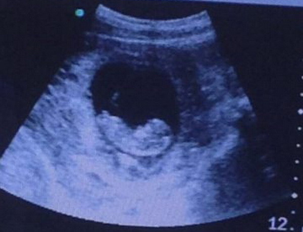 Aceasta ecografie i-a ingrozit pe toti: ce au vazut langa bebelus. Imaginea, distribuita de 500.000 de ori in 24 de ore