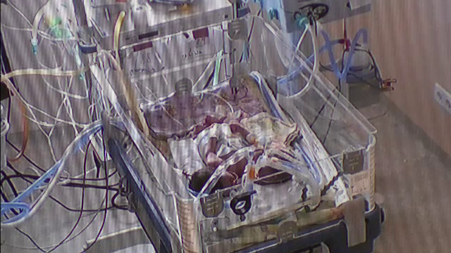 Stefania si Cristiana, siamezele nascute acum o luna la Constanta, au murit la Marie Curie