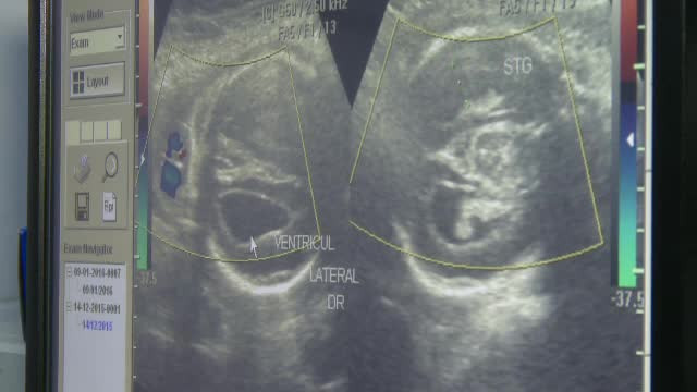 O sarcina in care copilul "nu are cerul gurii si are malformatii grave", catalogata drept "normala". Acuzatiile unei gravide