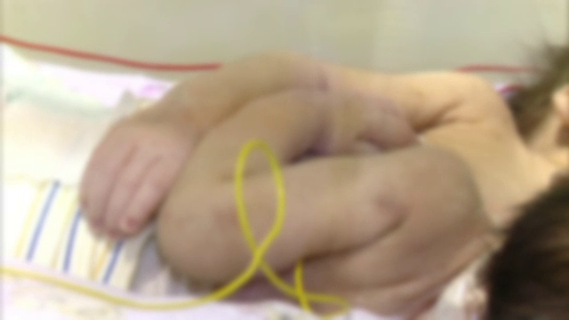 Cele doua siameze din Constanta au fost botezate. Vestea proasta pe care au primit-o parintii: "Nu se poate face nimic"