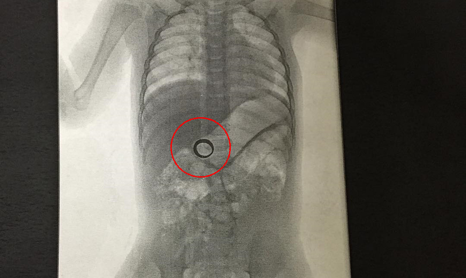Au ajuns cu copilul la spital, iar medicii i-au facut o radiografie. Surpriza parintilor cand au vazut ce inghitise micutul
