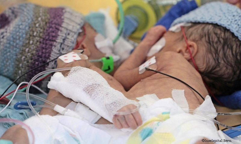 Premiera medicala in Elvetia. Doua surori siameze au fost separate cu succes la doar 8 zile de la nastere. Cum arata acum