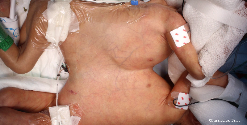 operatie siameze Elvetia