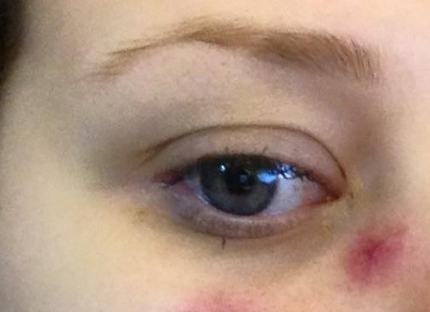 "Pielea mi s-a facut verde si m-am umplut de iritatii". Cum a ajuns sa arate o tanara dupa ce a folosit o crema autobronzanta