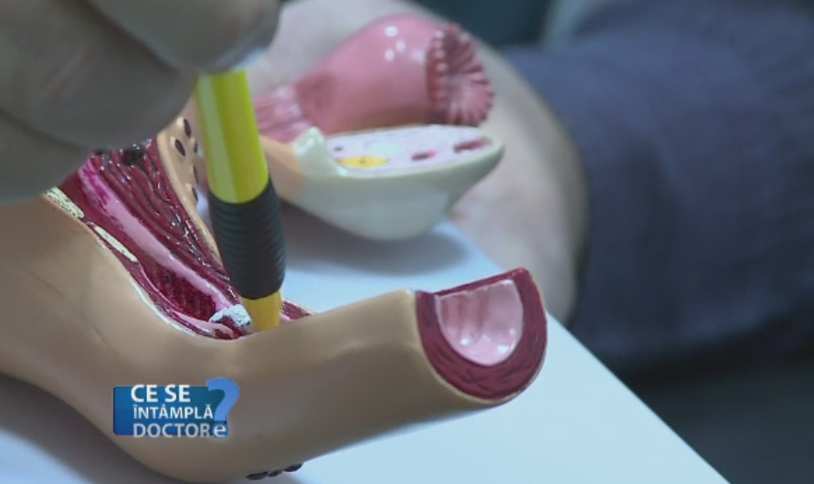 O igiena incorecta poate duce la cea mai frecventa infectie vaginala, candidoza. Care sunt cele mai frecvente greseli