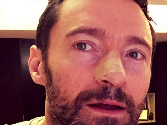 Hugh Jackman a suferit o noua interventie pentru indepartarea unor celule canceroase. Este a cincea in ultimii doi ani