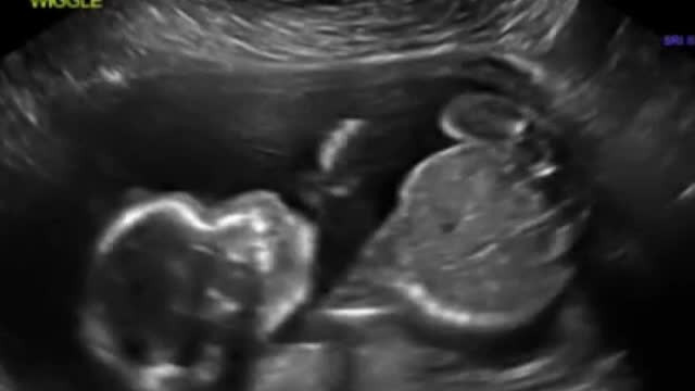 Ecografia in care un bebelus isi da singur un pumn in gura. "L-am intrebat pe medic daca a patit ceva"