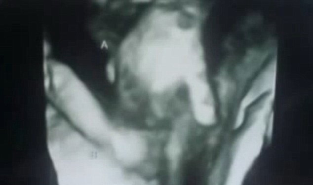 Adevarul sfasietor din spatele acestei imagini. Ce au aflat parintii dupa ce au vazut ecografia cu gemeni