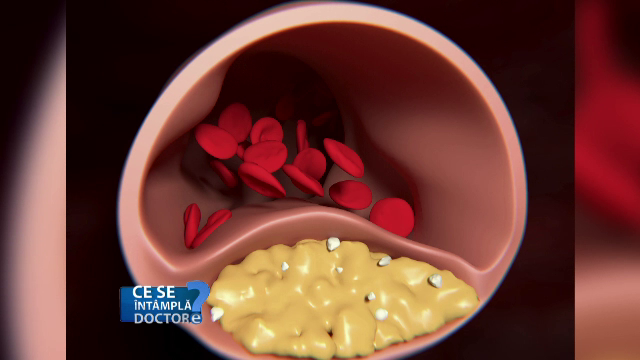 Imbatranirea vaselor de sange incepe din copilarie. In timp, se poate ajunge la afectiunea care omoara cei mai multi oameni