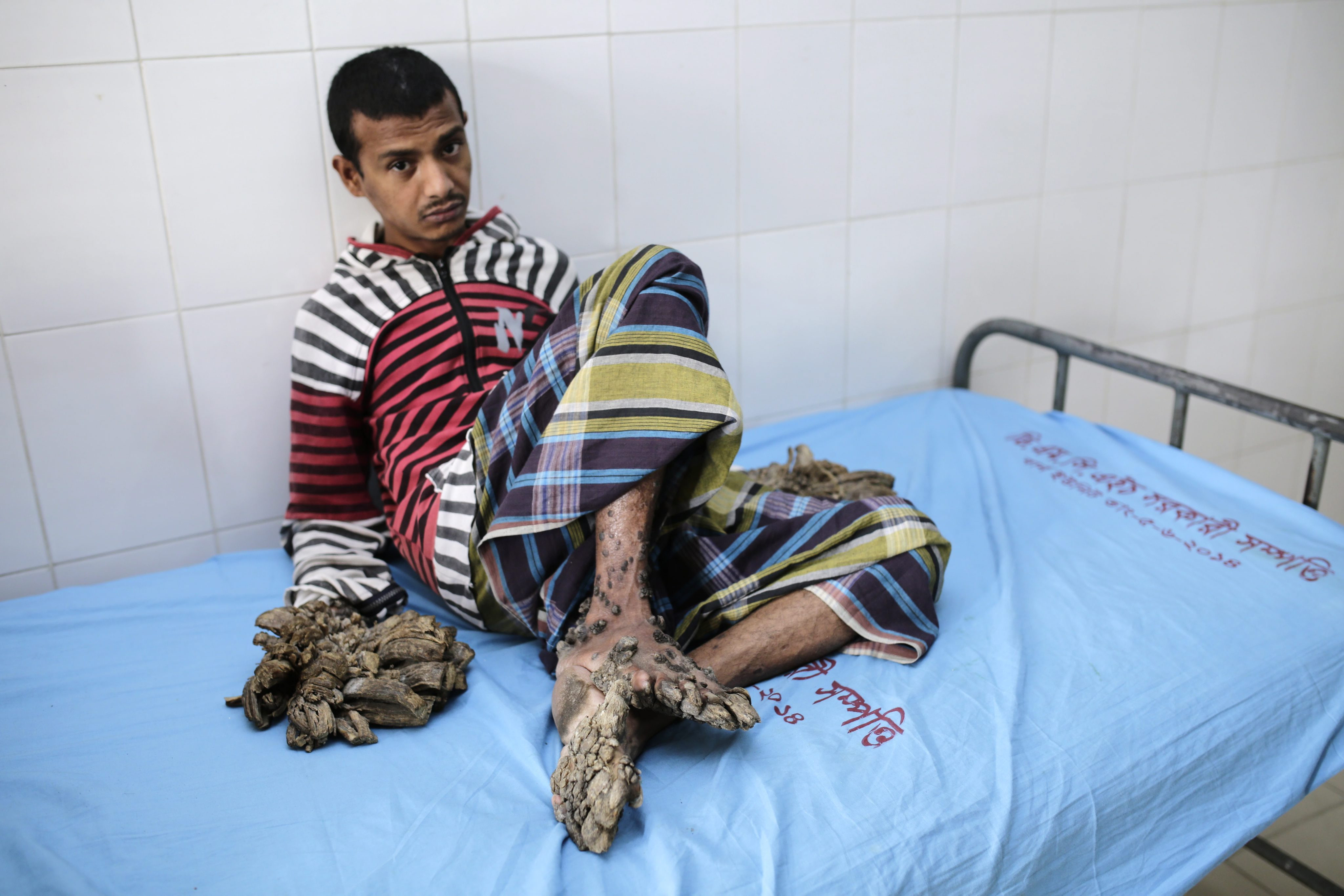 "Omul copac" din Bangladesh a fost operat la maini, dupa o interventie care a durat 3 ore. "Este fericit si a ras"