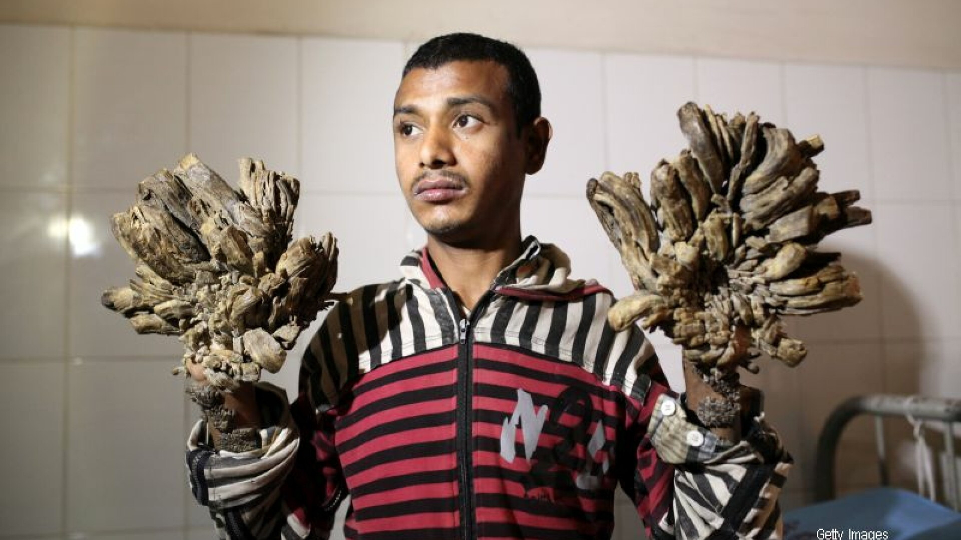 Prima raza de speranta pentru “omul copac”. Barbatul incepe o serie de operatii pentru indepartarea excrescentelor