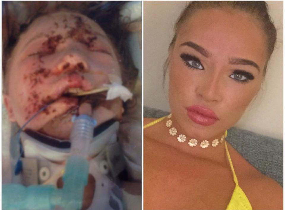 Si-a fracturat "aproape fiecare os din corp". Cum arata acum adolescenta care la 11 ani avea fata desfigurata