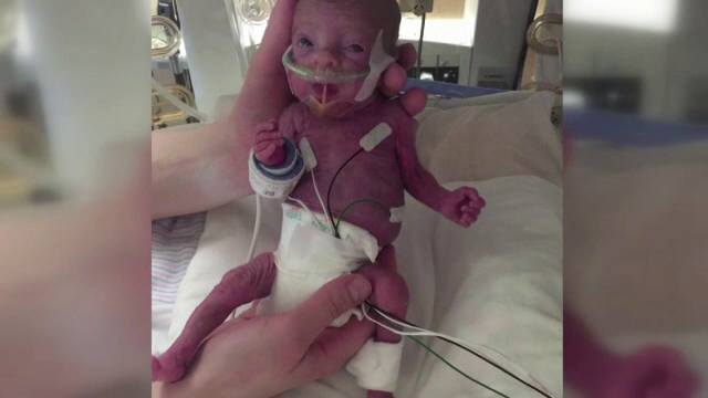 Cand s-a nascut, avea intreg bratul cat un deget de om mare si cantarea 400 de grame. Cum arata bebelusul la 3 luni