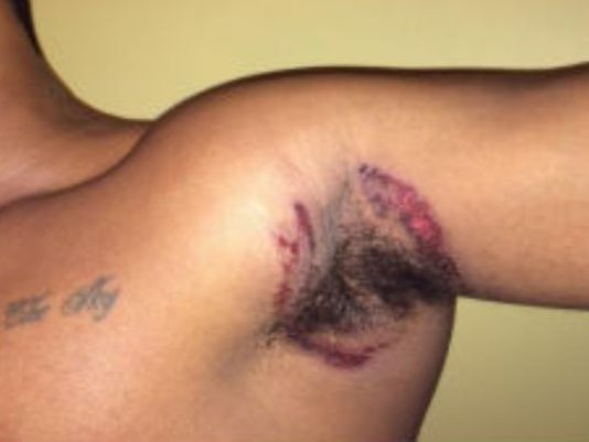 Sute de americani se plang ca s-au ales cu iritatii dupa ce au folosit un cunoscut deodorant. Produsul se vinde si in Romania