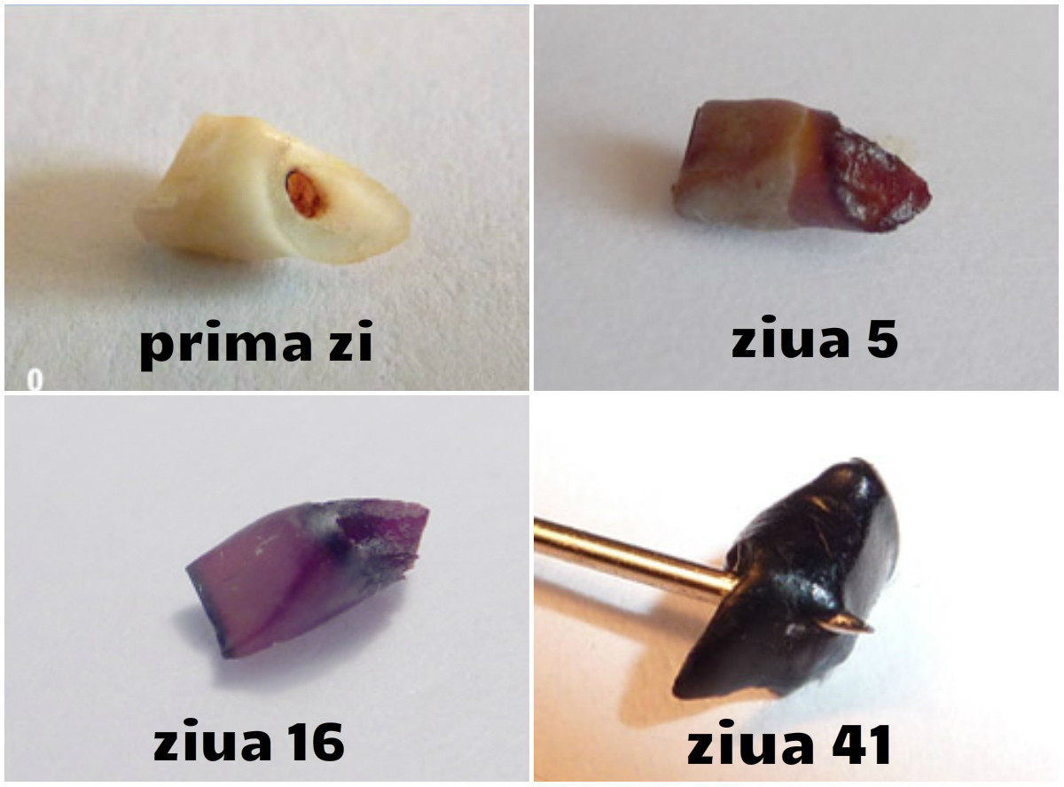 Experimentul care te va infricosa! A lasat un dinte in suc timp de 41 de zile! Cum arata la final